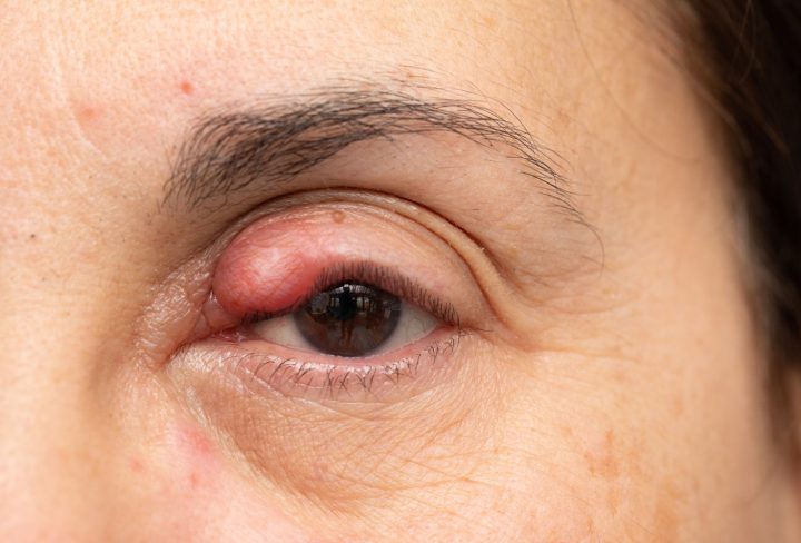 How to Get Rid of a Chalazion: Effective Home Remedies and Medical Treatments